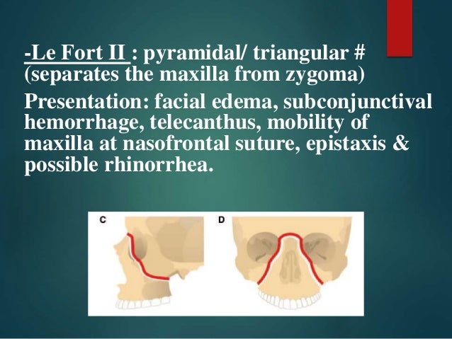 facial fracture slideshows Facial fracture slideshows